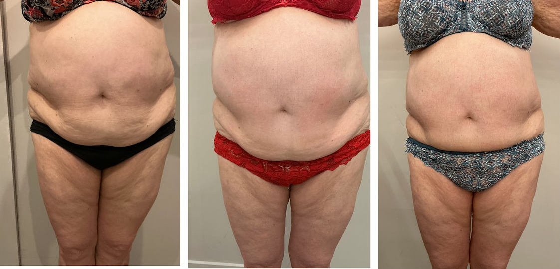 BodySculpt avant / après : résultats sur 3 patientes