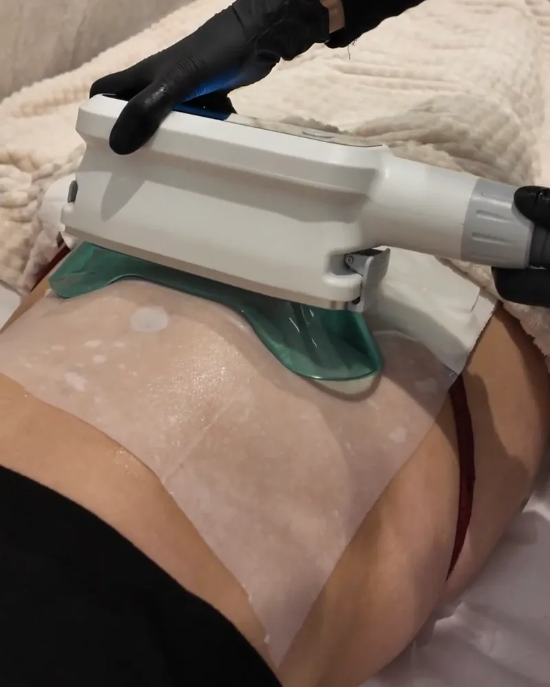 Applicateur de cryolipolyse en place sur le ventre pendant une séance chez Oraskin à Lille