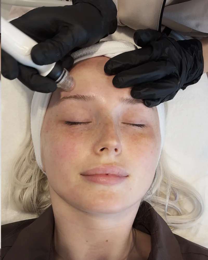 Embout d'hydro-microdermabrasion passé sur la joue pendant un soin Hydraskin chez Oraskin à Lille