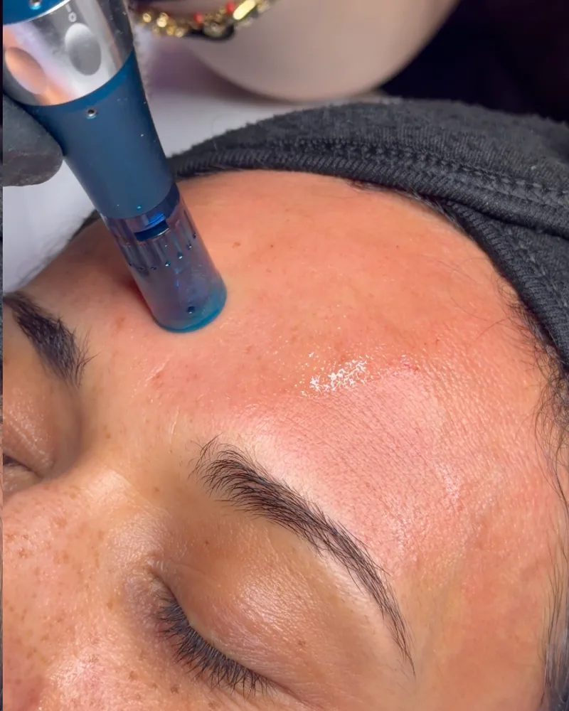 Stylo de microneedling passé sur le front pendant une séance chez Oraskin à Lille