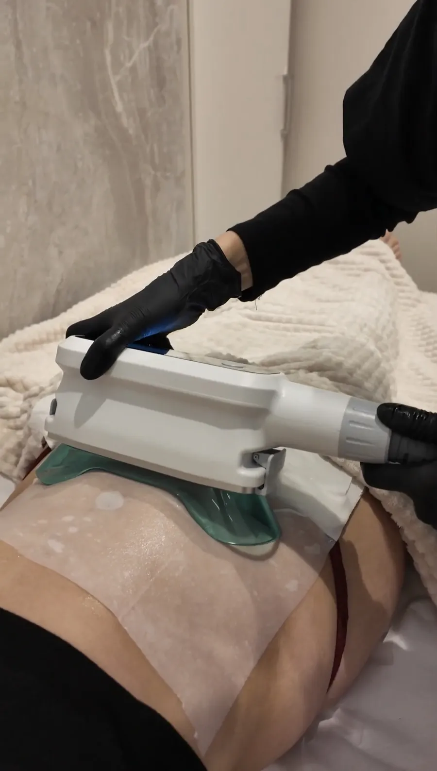 Séance de cryolipolyse chez Oraskin : applicateur posé sur le ventre et maintenu par une praticienne gantée